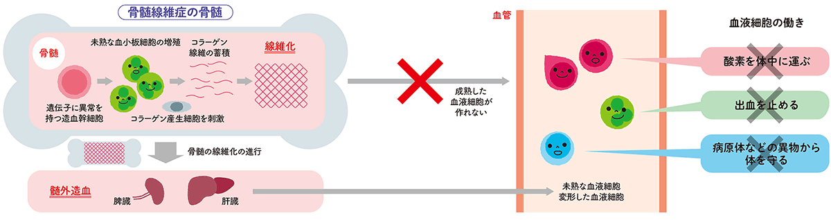 膠原病のひとつ